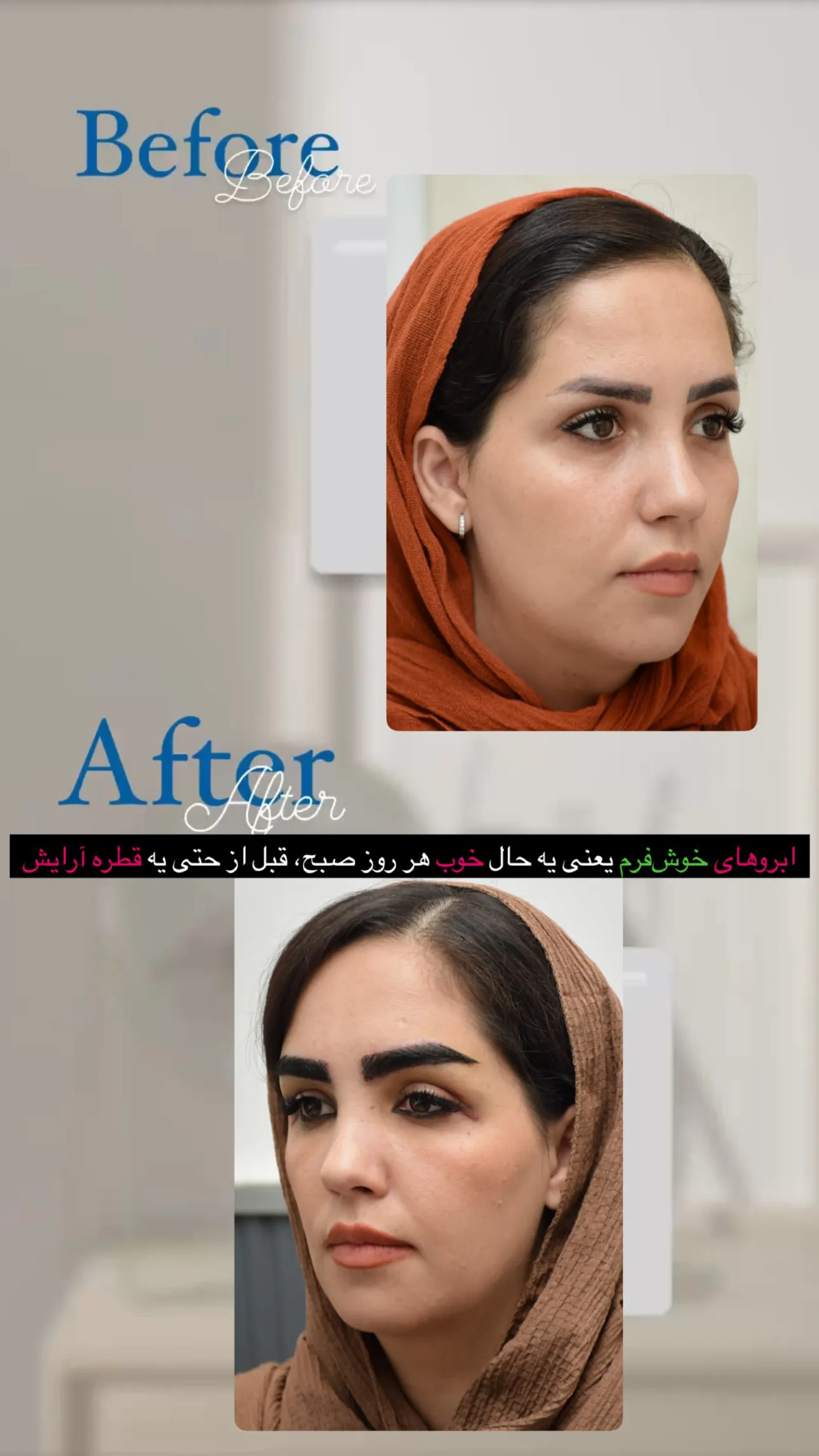 نمونه کار کلینیک کاشت ابرو مشهد